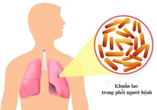 Bệnh lao: Nguy cơ lây nhiễm cao