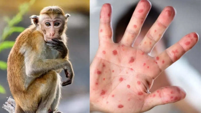 Chủ động ứng phó với bệnh đậu mùa khỉ