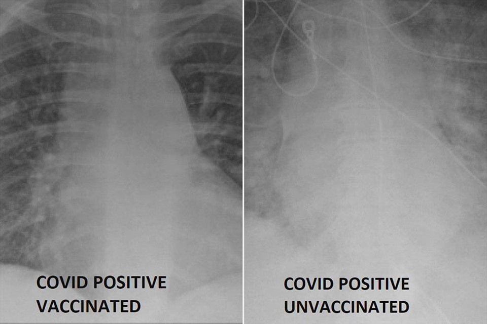 Sự khác nhau giữa phổi bệnh nhân COVID-19 được tiêm và không tiêm vaccine
